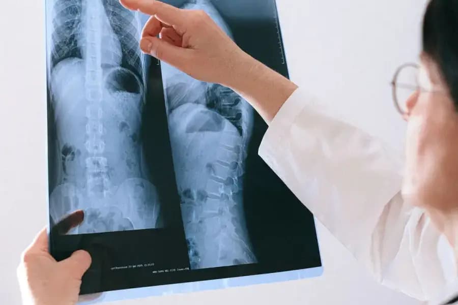 Cervical spondylosis physiotherapy Bangalore — anatomical illustration of cervical spine wear-and-tear, disc degeneration and neck nerve compression treated at Pro Physiotherapy JP Nagar 8th Phase by Dr J Mazumdar PT